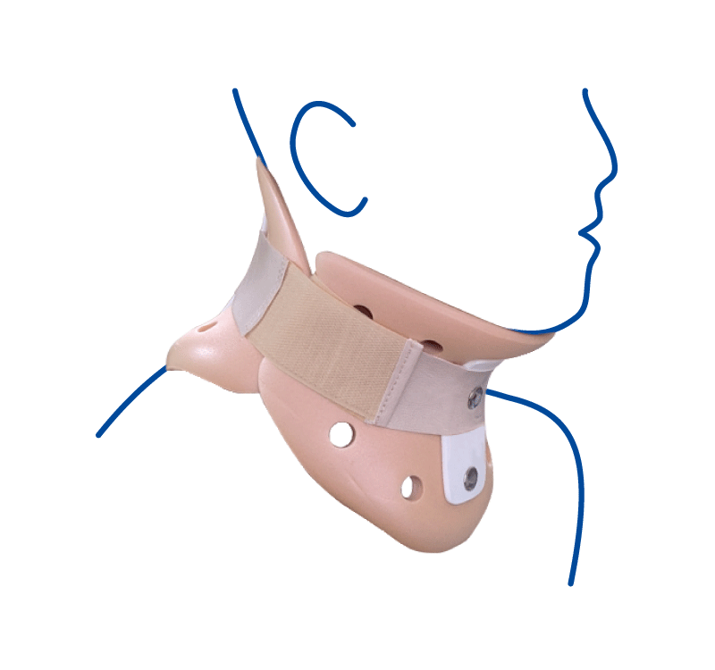 Rigid cervical spine orthosis (Philadelphia collar)